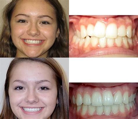 Transforming Lives, One Smile at a Time: The Power of Magical Teeth Braces